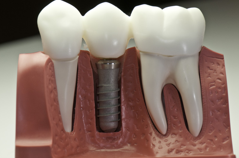 Zahnmodell mit einem Implantat und einer Brücke