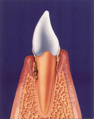 Zahn im Knochenfach mit Konkrementen entzündetes Zahnfleisch